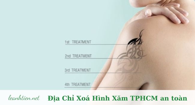 xoá hình xăm không sẹo